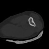 SPORK, NICO - 22.03.1976 - 02.08.2022 - CT obere Extremität - 18:02:23
